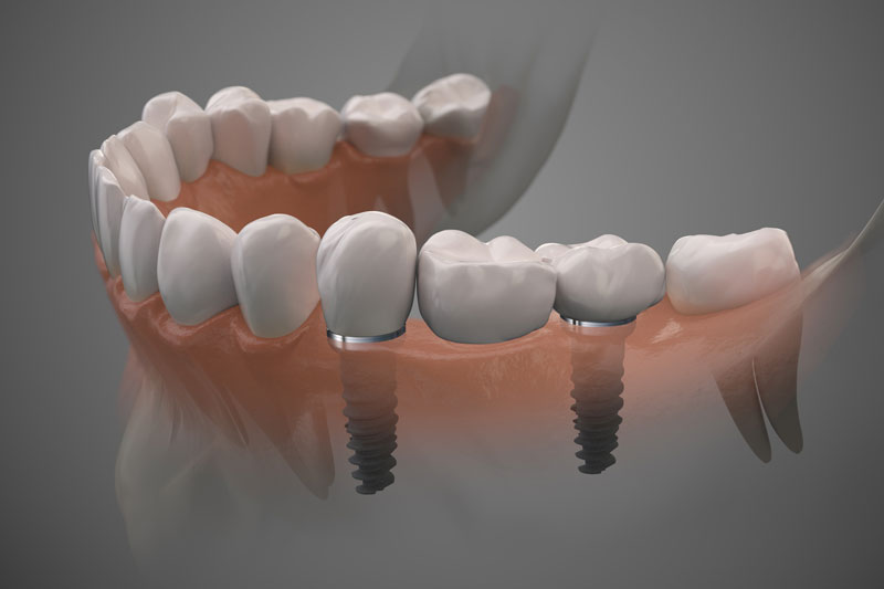 Proper Oral Hygiene for Dental Implants