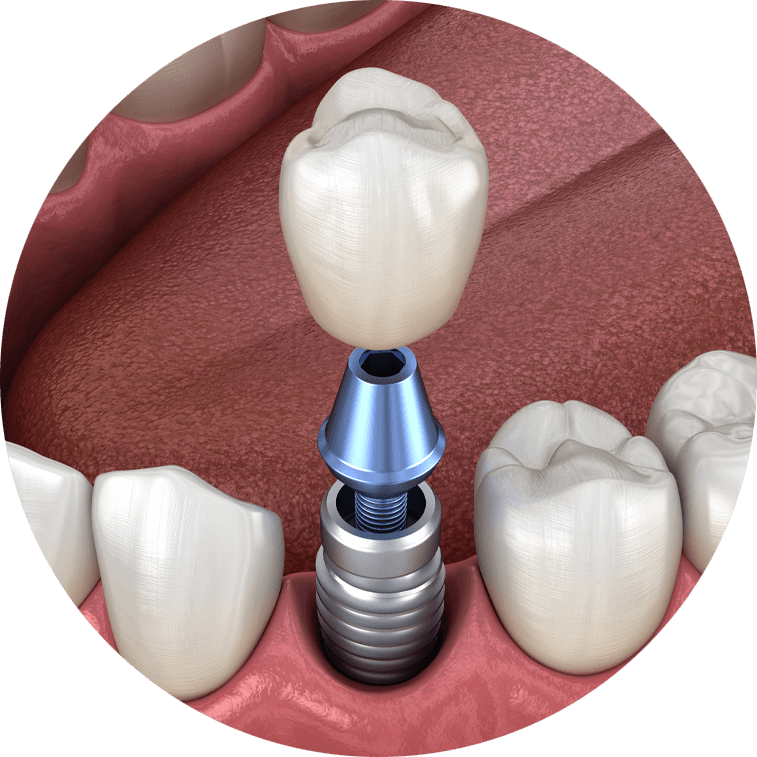 dental implants model 