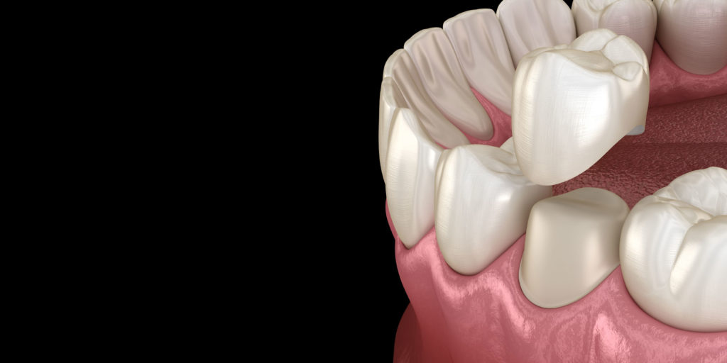 dental crown model  x