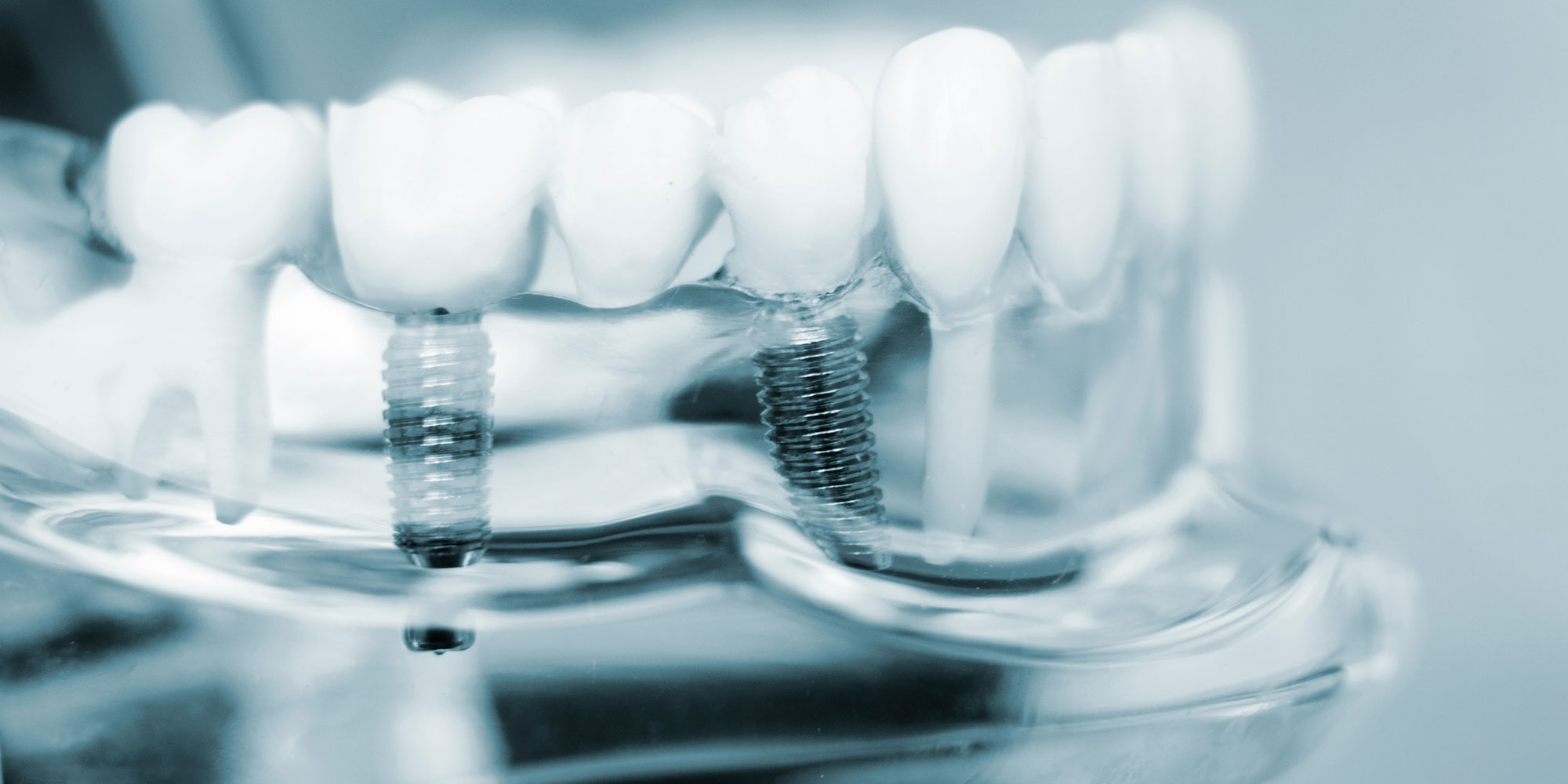 dental implants