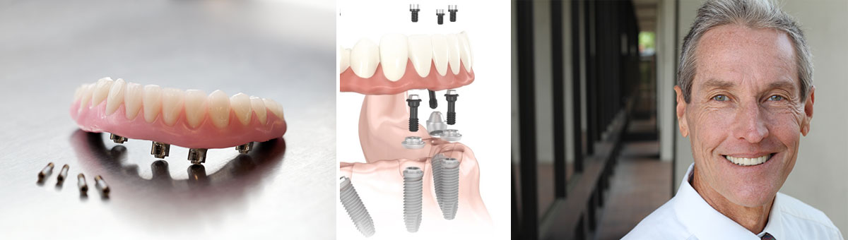 All-on-4 Dental Implants: An Overview