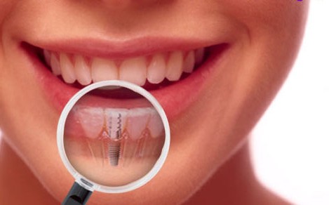 Proper Oral Hygiene for Dental Implants