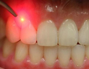 Is Laser Gum Treatment Right for You?