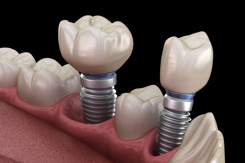 An image of a dental implant model.