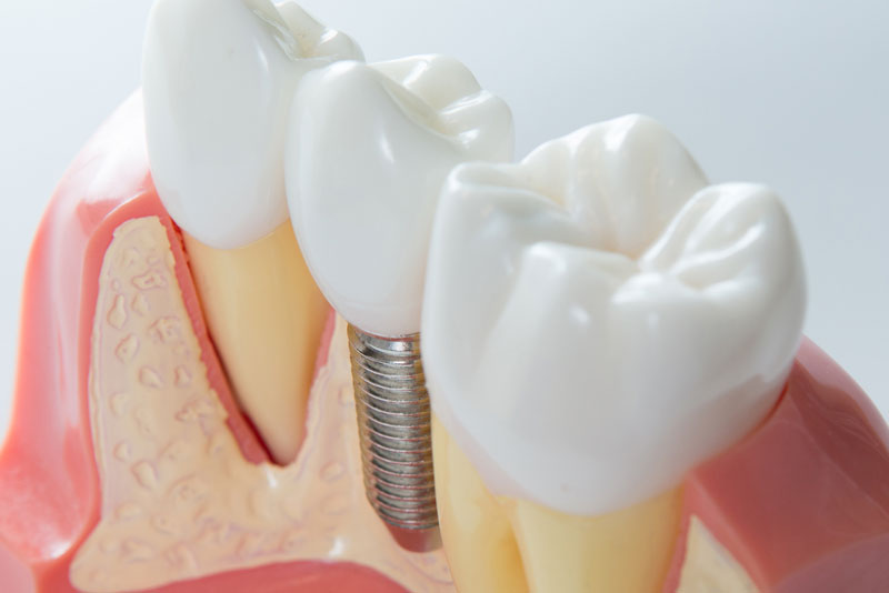 After Getting A Full Arch Of Teeth Extracted, Should I Get Treated With Full Mouth Dental Implants?