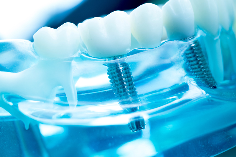 dentalimplants