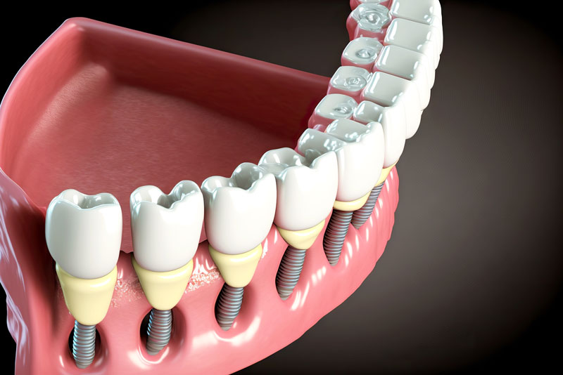 a 3-d model of a lower arch of dental implants with exposed post and crown.