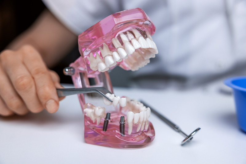 dentist implantologist showing dental bridge implant technology on human tooth.