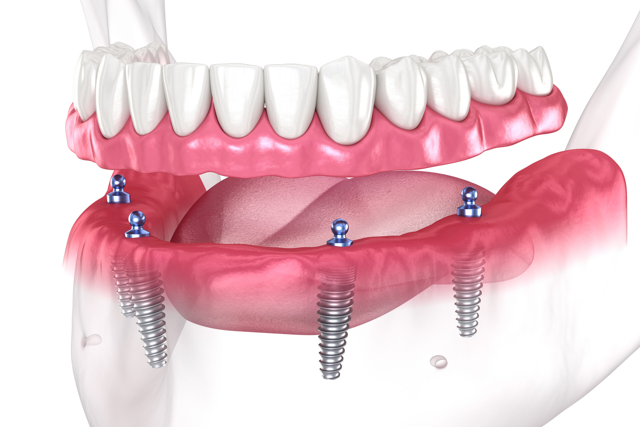 Am I Going To Benefit From Getting Treated With Full Mouth Dental Implants In Missoula, MT?