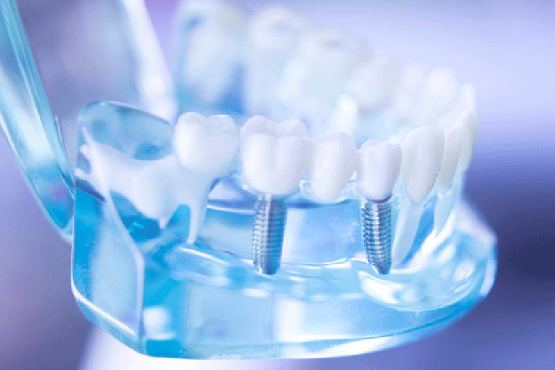 Why Are Abutments Needed In Dental Implant Procedures?