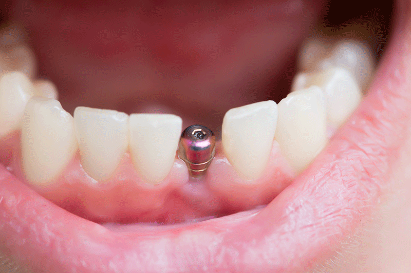 How Many Missing Teeth Can Dental Implants Replace?