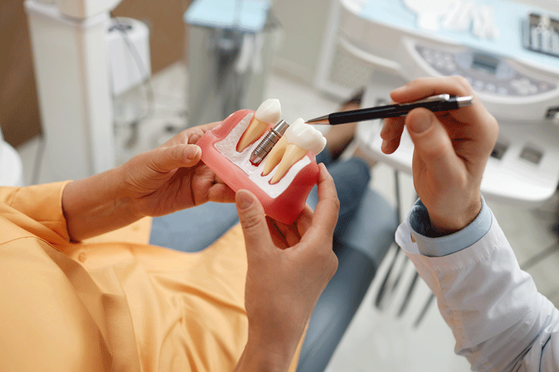an image of dental implants.